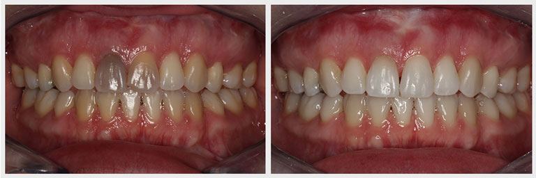 resin restoration of dark tooth