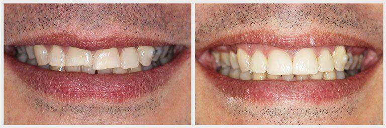 restauracion con resina de diente partido