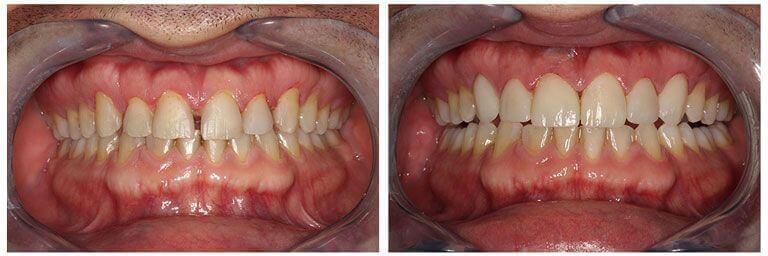 dientes frontales mejorados con resina