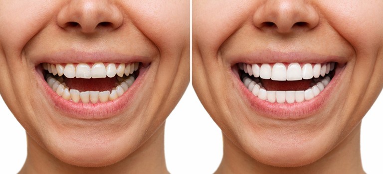 Why use dental veneers