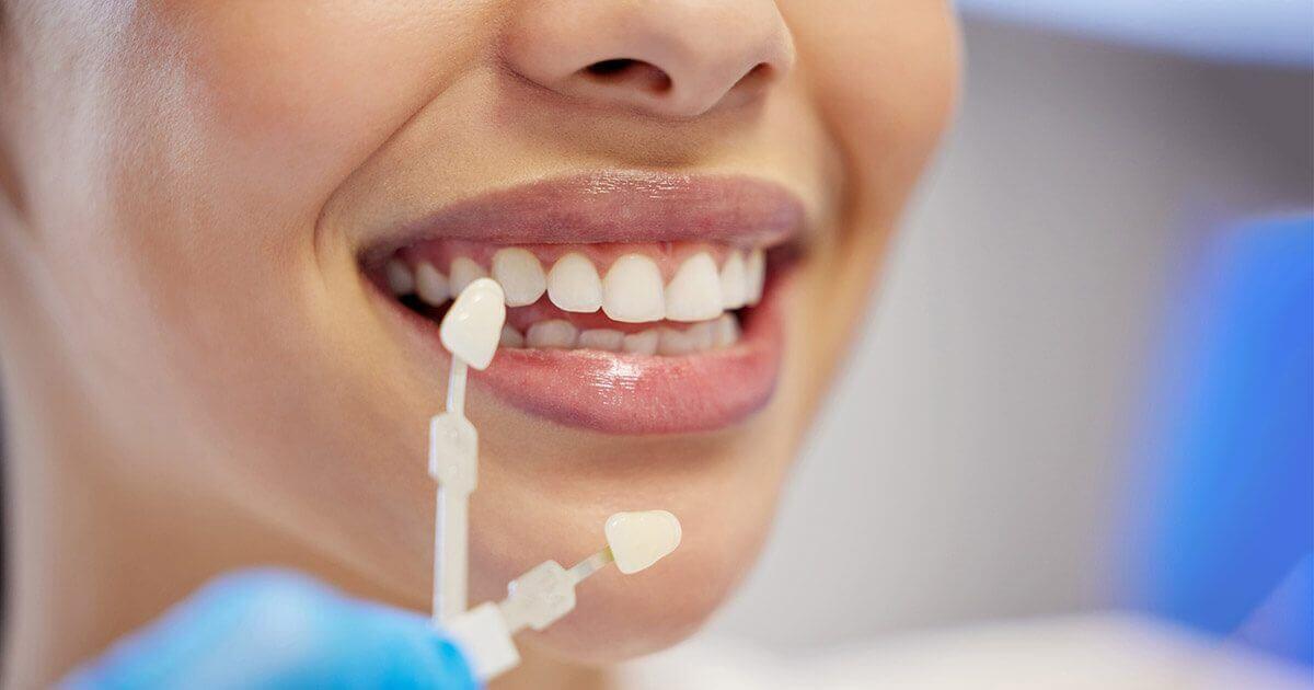 How dental veneers help improve your smile