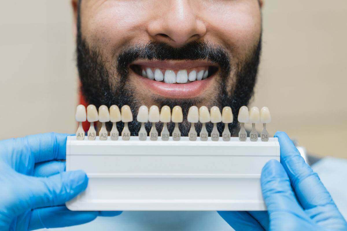 Beneficios de las carillas dentales o veneers