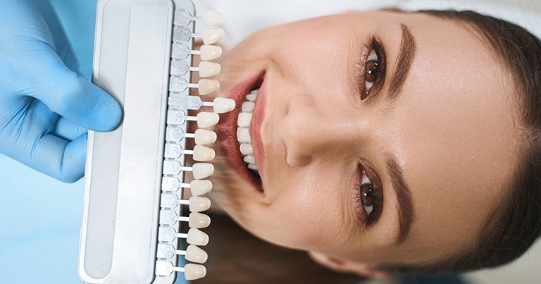 Cómo pueden ayudarte los laminados dentales