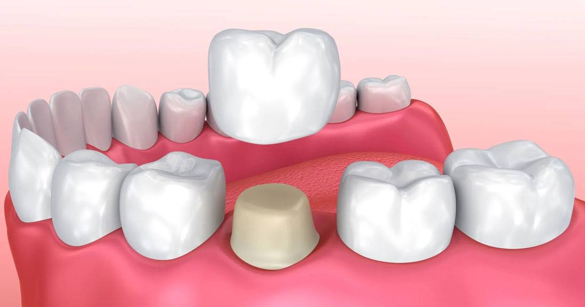 ¿Cuánto tiempo duran las coronas dentales?