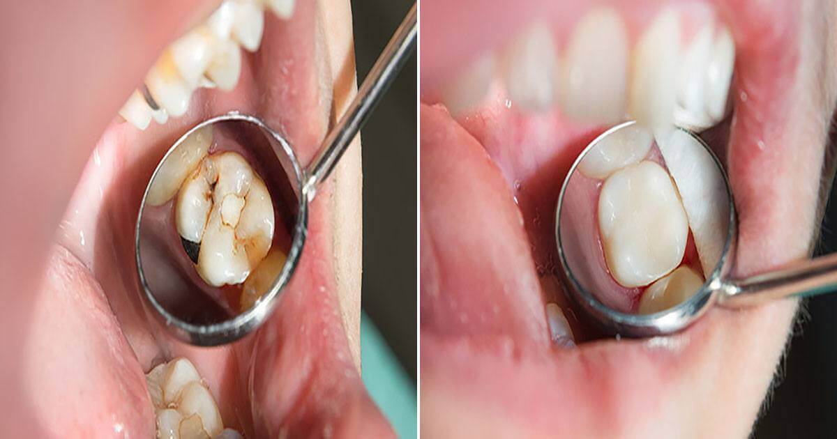 Lo que debes saber sobre las resinas dentales