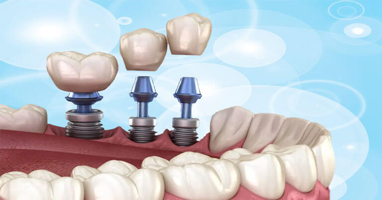 Price of dental implants in Puerto Rico