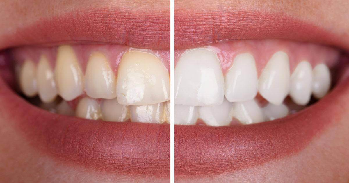 ¿Qué es un blanqueamiento dental? Y ¿Por qué debo recurrir a este tratamiento?