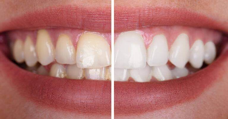 Blanqueamiento dental: ¿Qué es? Y ¿Por qué debo recurrir a este tratamiento?