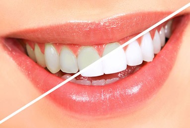 Teeth Whitening