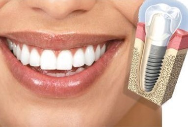 Dental Implants