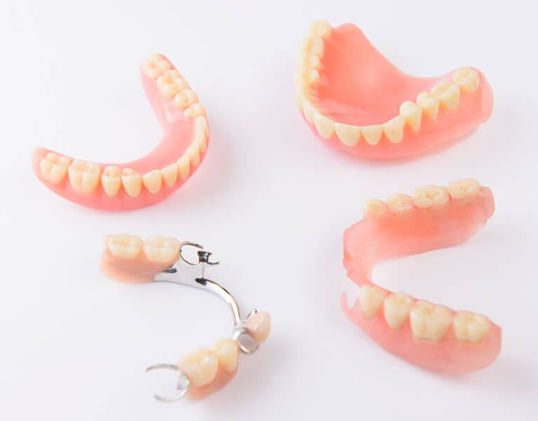 Tipos de puentes dentales